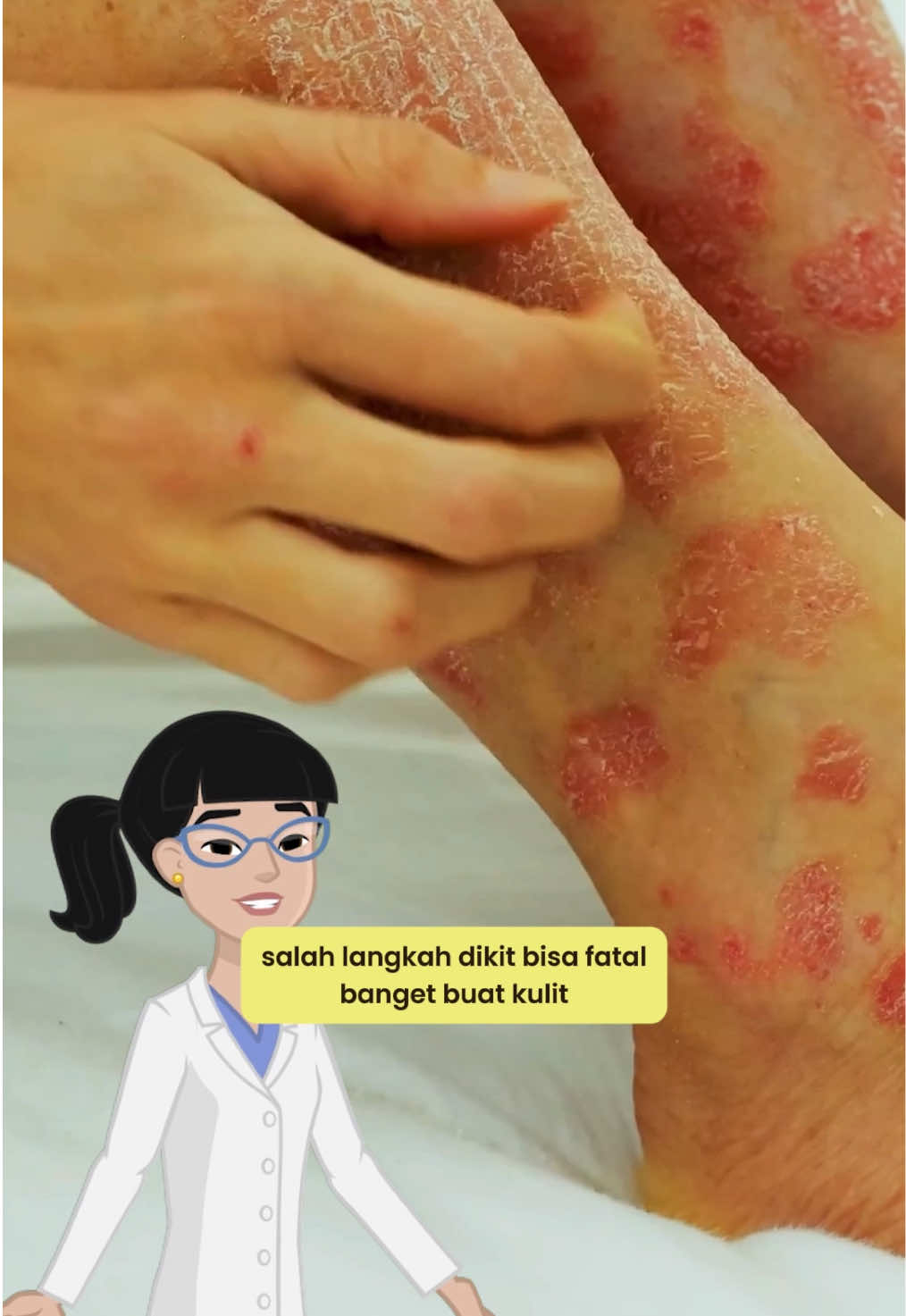 Eksim kering dan eksim basah yang bisa berujung FATAL 💀 #eksim #eczema #expert #suplemenherbal #kapsida 
