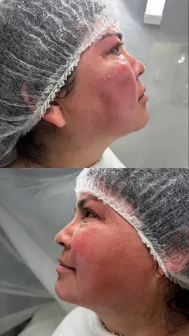 ✨ Resultados increíbles con Endolift + cuidados postoperatorios ✨ Nuestra paciente se realizó un Endolift en @chinitasbydailyn donde se están haciendo los mejores Endolift de Miami.  💆‍♀️ ¿Por qué hacemos masajes después del Endolift? Aunque es un tratamiento no quirúrgico, el Endolift genera un efecto térmico en la piel que puede producir inflamación, retención de líquidos o acumulación de subproductos del metabolismo celular. 🔹 Los masajes postoperatorios ayudan a: ✔️ Drenar líquidos retenidos ✔️ Reducir la inflamación más rápidamente ✔️ Mejorar la circulación linfática ✔️ Optimizar y acelerar los resultados del tratamiento Los cuidados post son parte clave para obtener un resultado más armonioso y duradero. 🌟 Llámanos hoy y agenda tu cita al 786-622-7958 📱  #postop #massage #tratamientos #postoperatorio #post #reinasdelasys #todassomosreinas #endolift