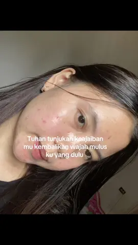 #jeratjerawat #bekasjerawat #acnefighter #katakata 