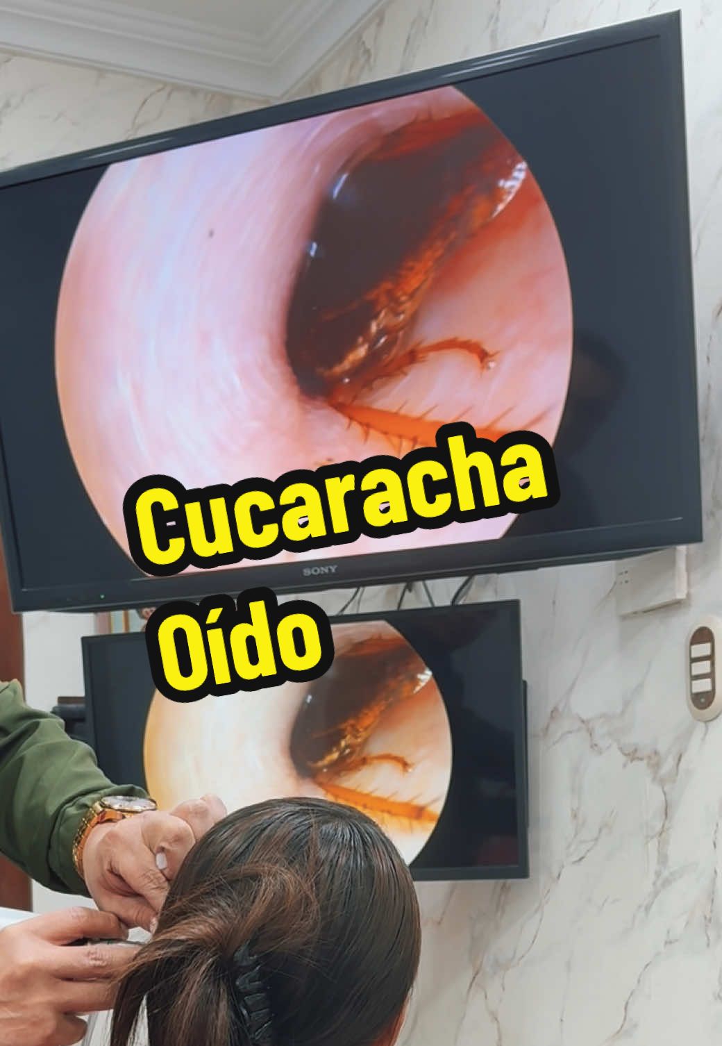 Paciente nos visita por insecto en el oido izquierdo. Cucaracha #oidoslimpios #oidoadultos #doloroido #oidoinfeccion #oidossucios 