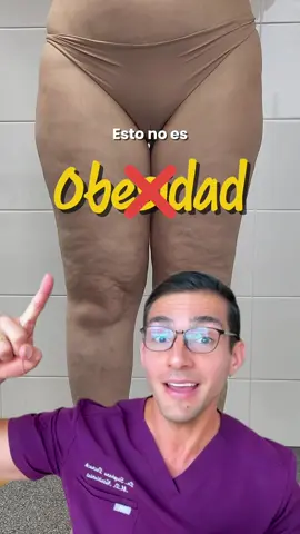 El lipedema se puede confundir con obesidad o celulitis! 👀 #salud #nutricion #ejercicio #dieta 