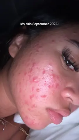 This is your sign if you struggle with acne that it definitely can get better! I big mistake that I made was not reaching out for help sooner and not getting medical grade skincare when I knew I needed it ❤️‍🩹 #acne #skincare #acnejourney 