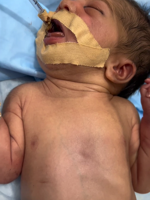 no breath baby on ventilator #unfreezmyaccount #newborn 
