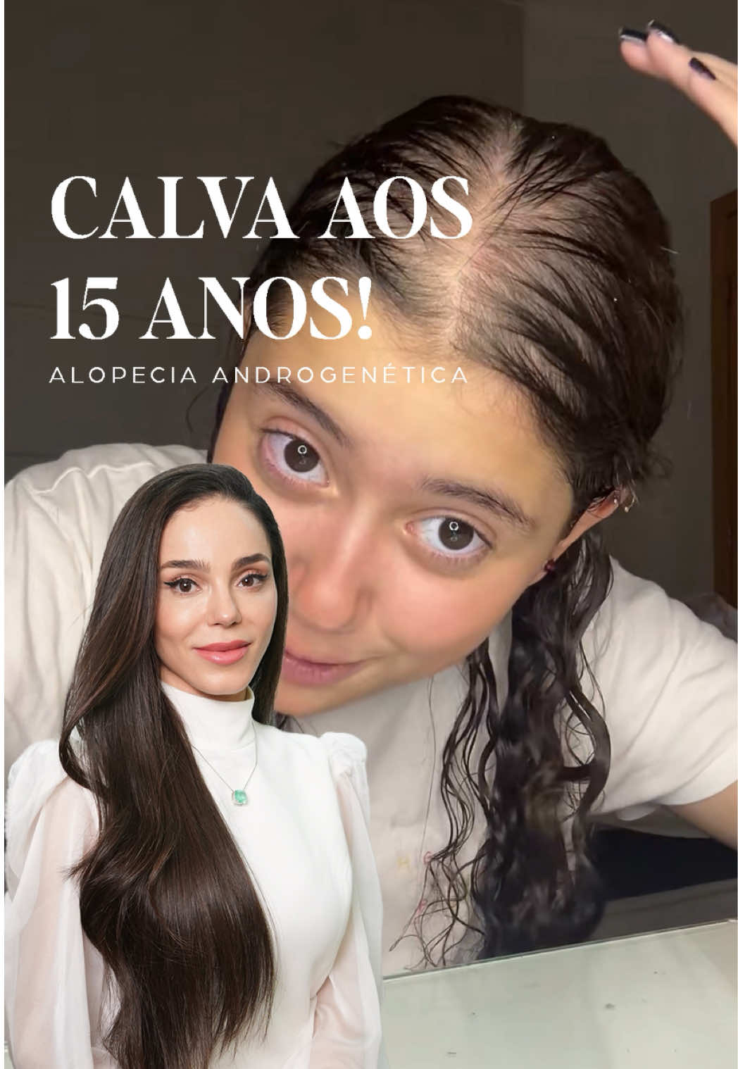 Adolescente com sinais de calvície aos 15 anos!😥 Laura, de 15 anos postou esse video aqui no Tiktok e recebeu diversos comentários sobre a calvície que já era visível. Foi só então que ela percebeu a gravidade do que estava acontecendo e começou a buscar ajuda. A alopecia androgenética em grau avançado nessa idade, é algo muito sério. Não se trata apenas de estética, estamos falando de genética e de saúde capilar. Quanto mais cedo o tratamento é iniciado, maiores as chances de preservar os fios. Porque quando o folículo morre, não existe volta.🫠 Se perceber sinais de queda acentuada, não espere. Procure ajude de um médico especializado o quanto antes! 😉