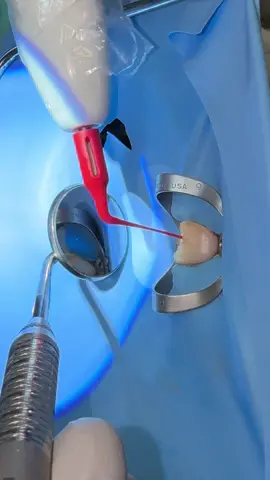 Yes. I irrigate and activate 6% hypo even in teeth with open apeces! #dentists #rootcanal #dentistry #dentalstudent #dentalhygienist 