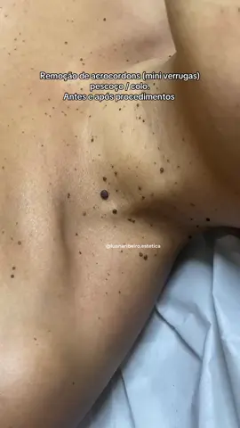 Remoção de acrocordons (mini verrugas) pescoço / colo.  Antes e após procedimentos #verrugas #remocaoverrugas #verrugasfaciales 