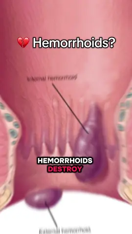 You’ve tried the rest… now try Hem Hero. #HemHero #ReliefThatWorks #TikTokFinds