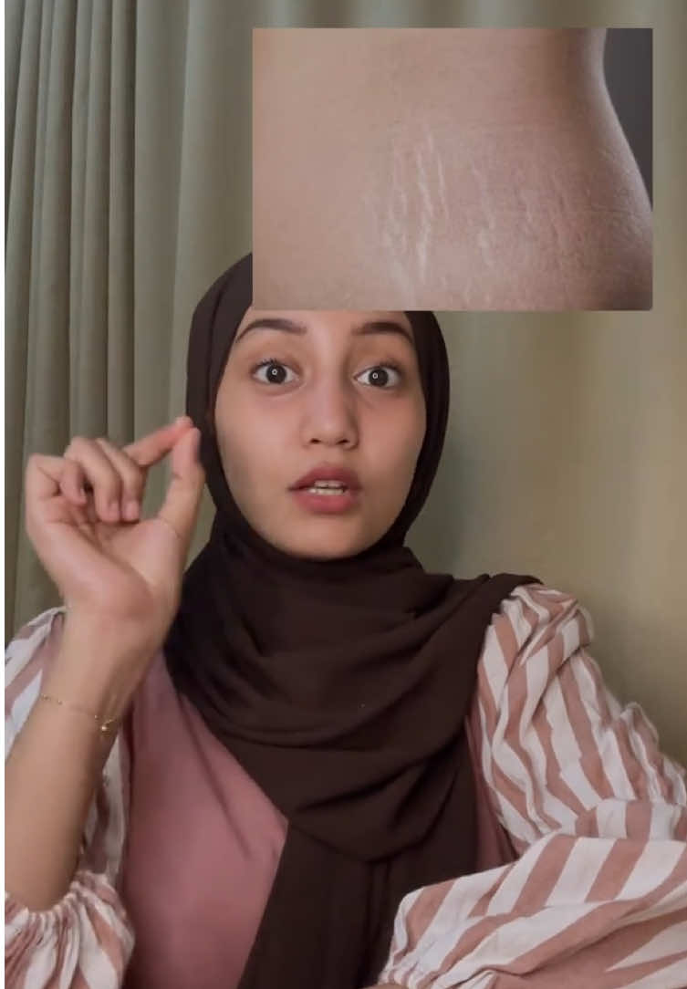 Jangan sampi tunggu sampai stretchmarknya kamu warna merah!😱 yuk pakai bambi mom stretchmark dari sebelum hamil yaa
