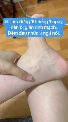 Kem bôi giãn tĩnh mạch cho ai cần nhé #suygiantinhmach 