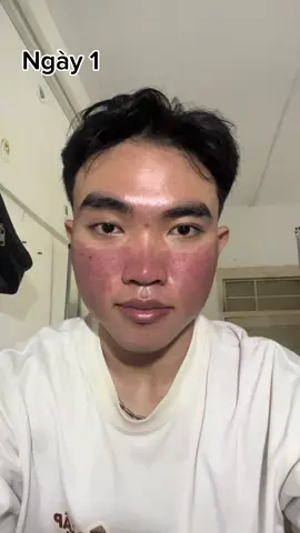 7 ngày sau điều trị sẹo rỗ lần 4. Giờ trị sẹo ráng chịu xấu 4-5 ngày đầu thui là mọi thứ quay về ban đầu rùi mn ơi, đi trị sẹo đi 😆 #fyp #xuhuong #triseo #thaydoibanthan 