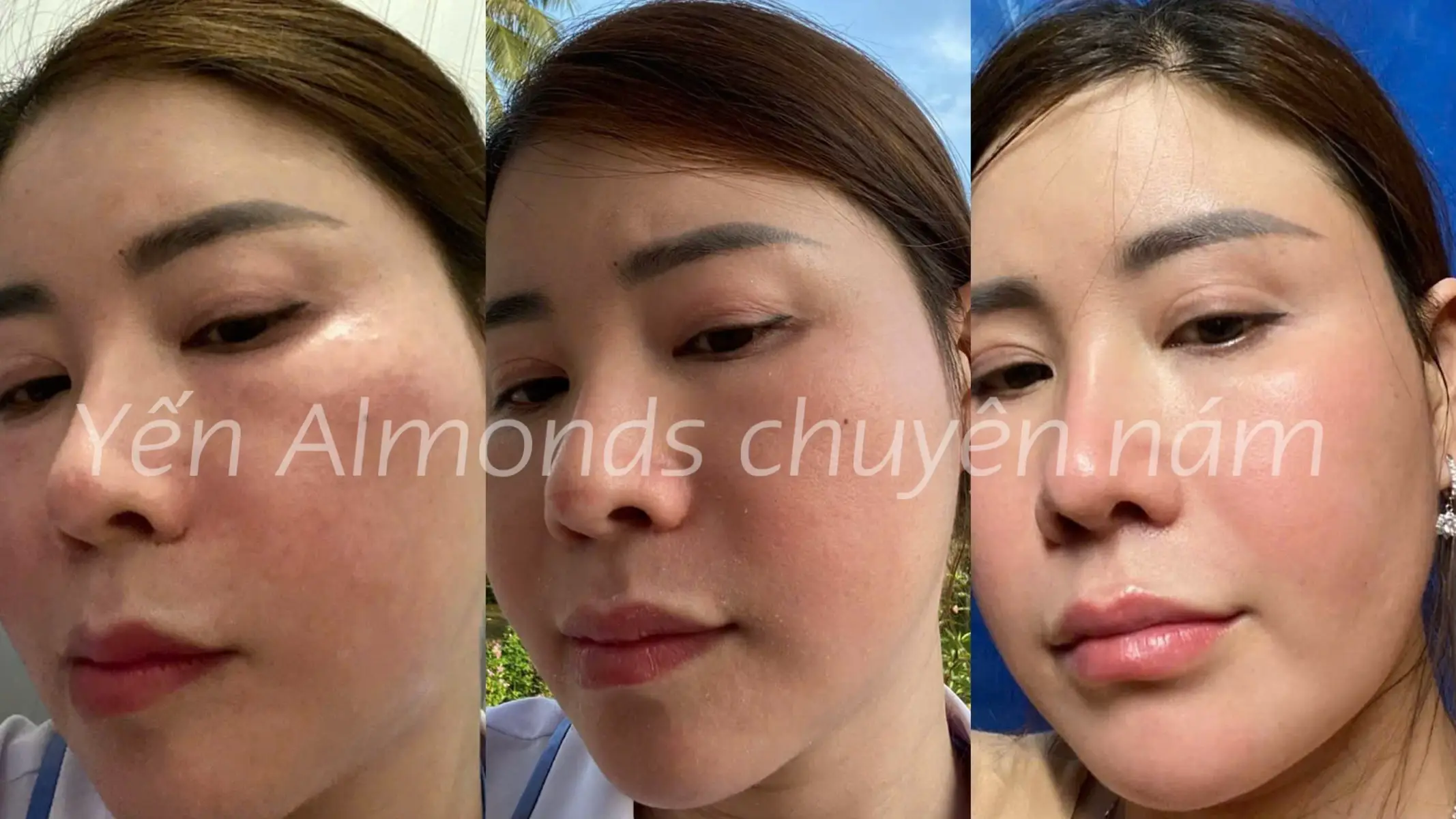 Hemo là chân ái Peel da hôm nay để Tết này có làn da rạng rỡ chị em ơiii #peel  #peelda  #peel da mặt trị mụn nam #almonds 