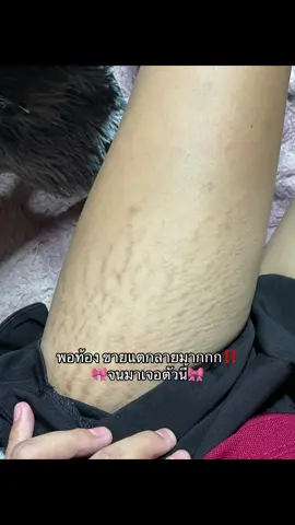 แม่ๆบ้านไหนที่ขาแตกลาย แม่บ้านนี้แนะนำค่ะ✅🩷🤍#ป้ายยาtiktok #ของดีบอกต่อ #ครีมลดรอยแตกลาย 