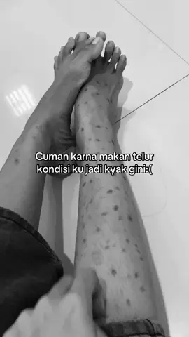 Kaki sebelah nya udah mulai gatal2 juga😫 #alergi #gatal #bekasluka #korengan #bauttitanium 