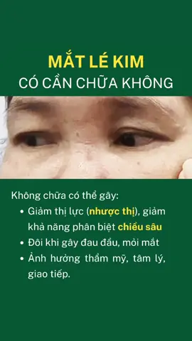 Mắt lé kim có phải làm gì không #xuhuong #trending #lekim