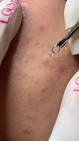 Ấn mụn #chamsocdaseo#chamsocda#chamsocdamun#chamsocdanam#tanbinh       