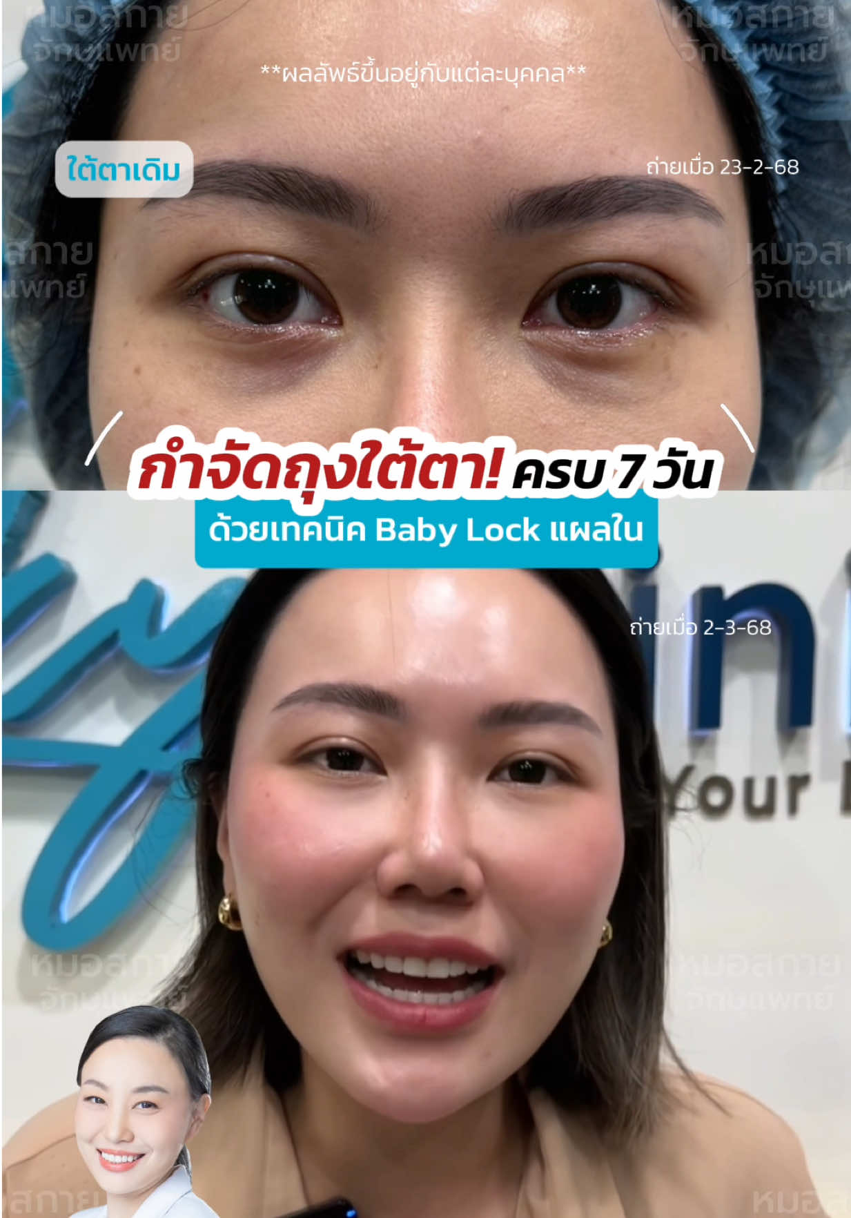 #กำจัดถุงใต้ตา ครบ 7 วัน‼️ ด้วยเทคนิค Baby Lock #กำจัดถุงใต้ตาแผลใน  #หมอสกาย #จักษุแพทย์ #skyclinic 