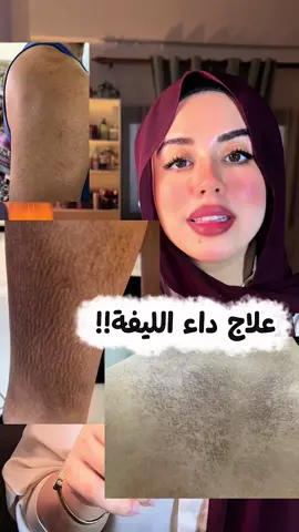 ⁨	داء الليفه او النشواني البقعي علاجه سهل قوي بس بياخد شوية وقت🤍✨ البنات الي مش في مصر هاتوا منتجات دي : Aplb salicylic acid bha ✨ yeouth sallicylic acid 20% ✨ My scheming niacin + salicylic✨ Anua peach 70 niacin✨ ‪@Derma.10  #بقع_بنية #داء_الليفة #النشواني_البقعي #سالسيلك_أسيد #نياسيناميد ⁩