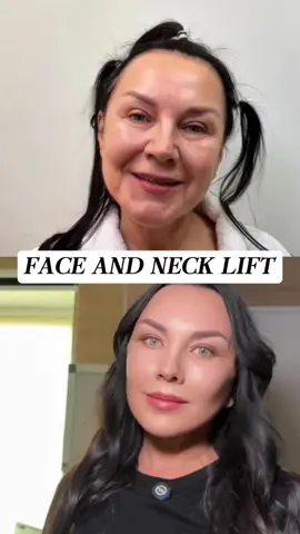 ⚖️ Confident at 65 ⚖️ A 65-year-old lawyer from the U.S. chose Dr. Wang’s high-SMAS facelift to restore his professional presence and confidence. By lifting the deep fascia layer, we addressed the true cause of sagging and aging. ✨ After 3 months: ✔️ His jawline is sharper and youthful ✔️ His face looks at least 10 years younger ✔️ Natural scars that blend seamlessly He shared: “Looking younger has given me new energy in my career. I feel sharper, more confident—in court and in life.” This is more than rejuvenation—it’s a boost of confidence for both life and career. #facelift #necklift #headlift #SMASlift #DeepPlaneFacelift   