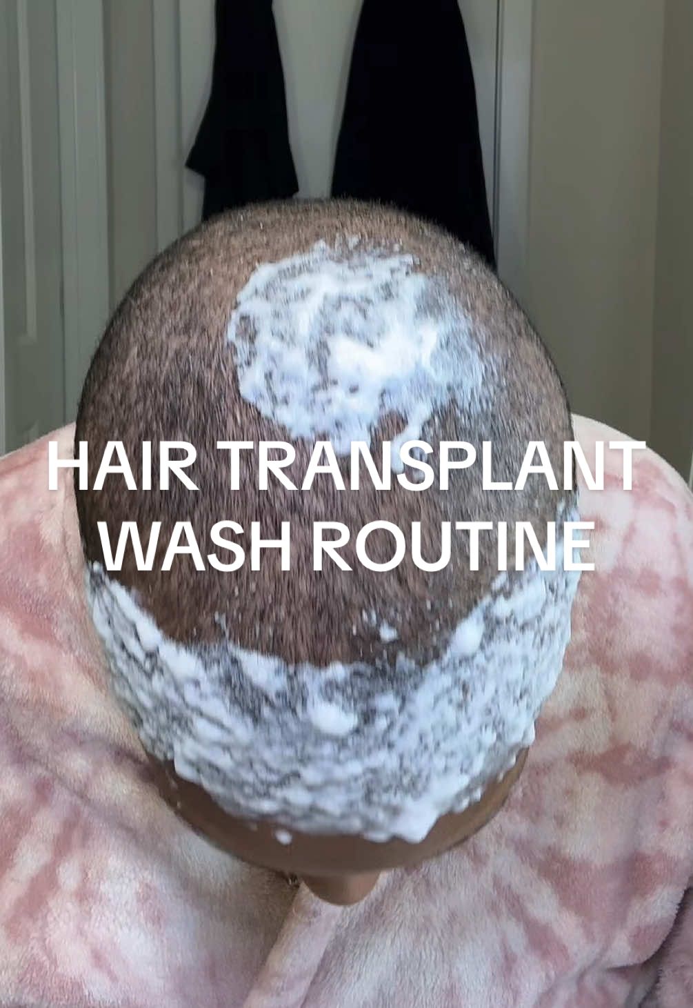 Hair Transplant Wash Routine 💕 Everyday gets easier but chileeeeeee 😩 I want to dip my head in a bucket 🪣 and no I can’t wash in the shower yet the water pressure is too hard. 😭 #hairtransplant #femalehairtransplant #hairtransplantjourney #hairtransplantturkey #tractionalopecia 