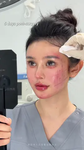 Motherhood changes many things — but your beauty doesn’t have to fade. 💖 With the 9D Facelift, tired, sagging skin is lifted and refined, bringing back the youthful glow and elegance you thought was gone. ✨ #9DFacelift #YouthfulFace #FacialRejuvenation #MomTransformation #TimelessBeauty 