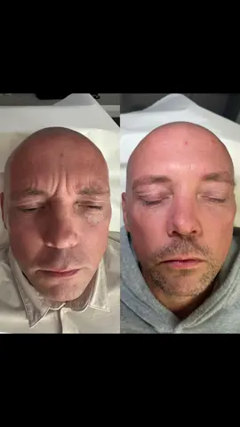 👀 Not just for girls… Men age too!!  Tell your Dads, Brothers, Sons, Uncles and Grandads !!! 🤣 Men often develop deeper forehead + frown lines because of stronger facial muscles 💪. Over time, these lines can make the face look tired, stressed, or older than it feels. 💉 Line-reducing treatments help by: ✨ Softening harsh lines while keeping a natural, masculine look ✨ Giving a fresher, more relaxed appearance (without looking “done”) ✨ Boosting confidence for work, social life, or just feeling good in your own skin It’s not about losing character, it’s about keeping you looking like your best self.  Fresh, natural, confident. 💌 Drop me a message and we can chat about how I can help you now🥰❤️ P.S Get your FREE ultimate glow-up guide! Link in bio now ✨ #aestheticstonbridge #lipfillertonbridge #lipfillerpaddockwood #aestheticspaddockwood #dermalfiller                 