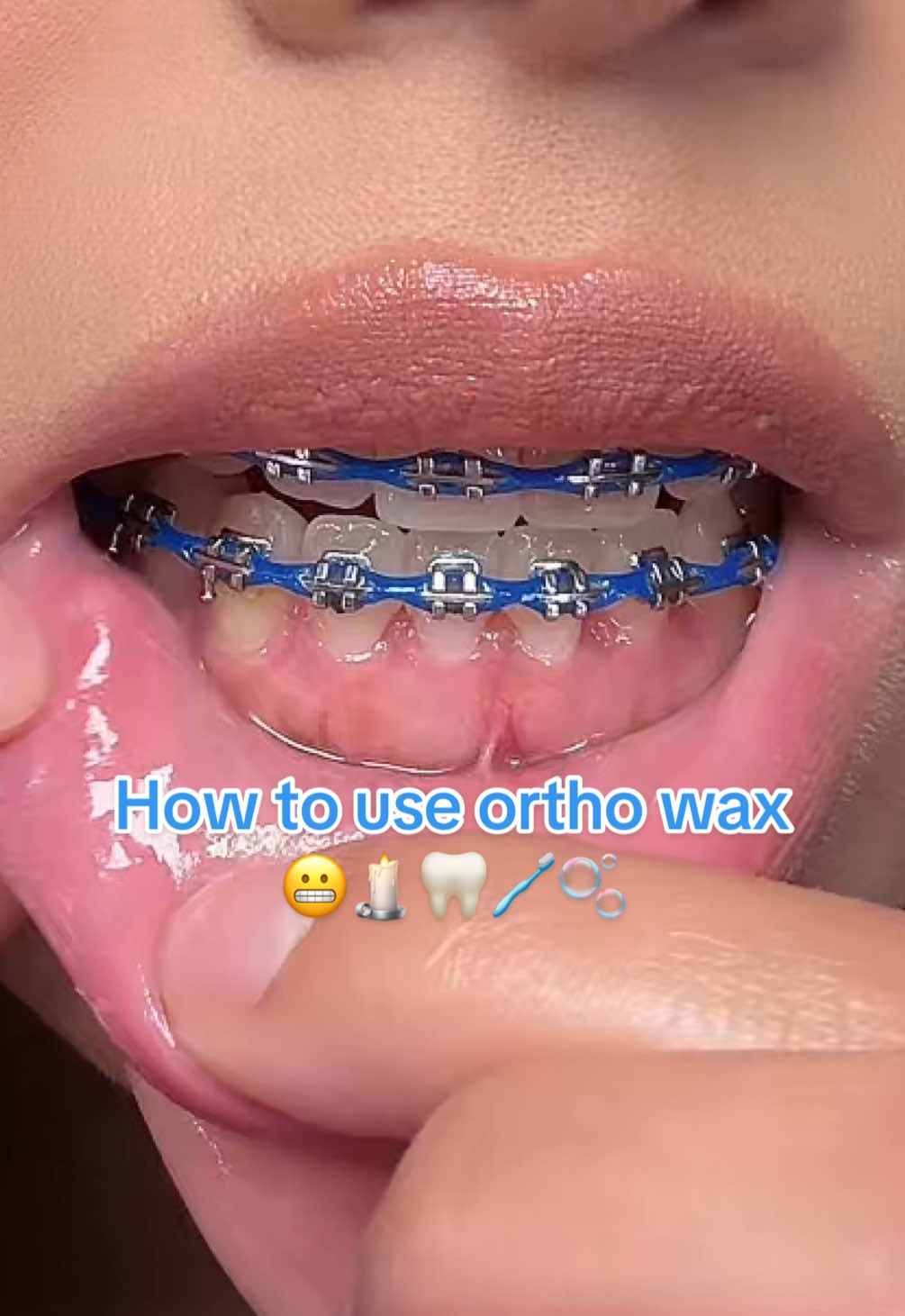 These hooks can cause so much pain and discomfort. Here’s the most easiest way to help when you’re experiencing this problem. #braces #bracesoff #bracescolors #bracestips #bracescheck #adultbraces #bracesjourney #ortho #othodontist #orthodontics #dentist #dental #dentistry 