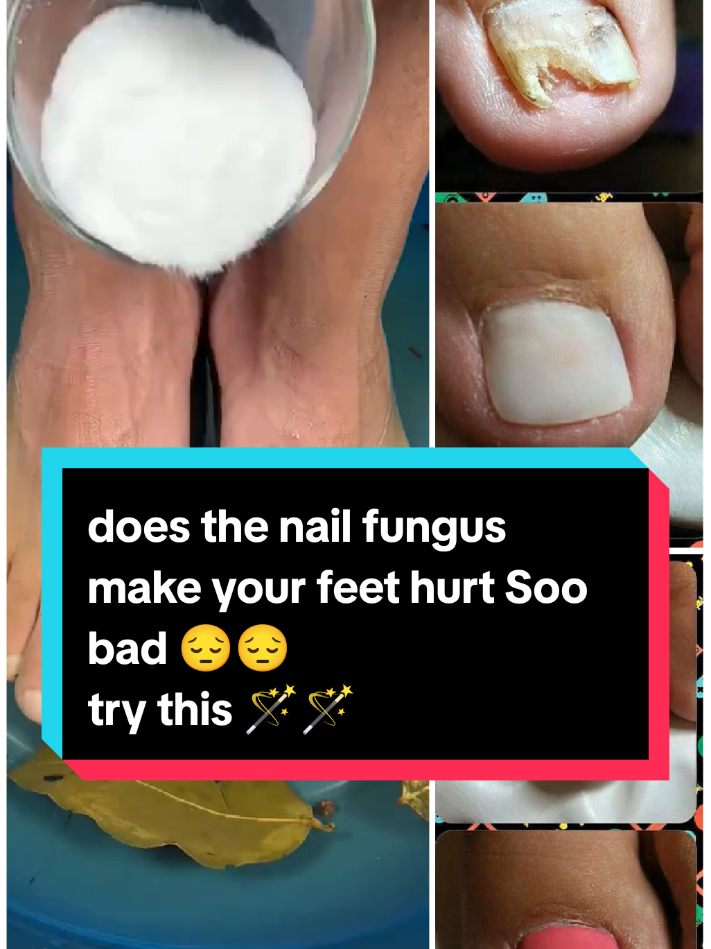 does your feet hurt Soo bad that you can't even stand 😯😯😯try this hack 🙈🪄 #mycosisfungoides  #healthadvice  #nailfungus  #nailfungustreatment  #naturalmedicine 