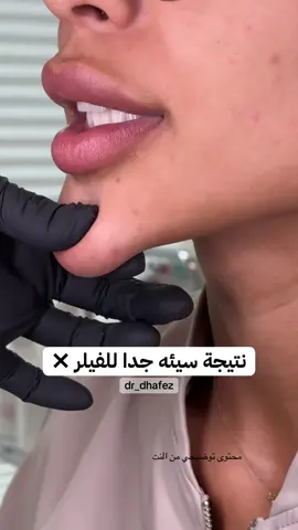 #ظافر_الحافظ #ظافر_ال_حافظ #فيلر_الذقن#فيلر_ذقن#الفيلر