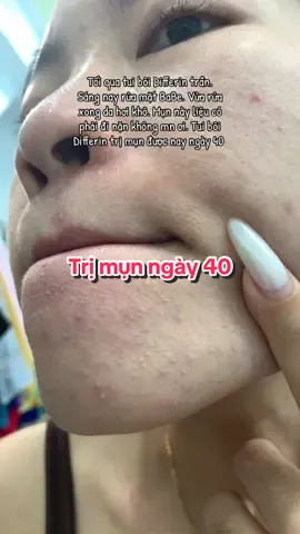 Ngày40/100 Tui thấy mụn chỗ cằm nhiều quá. Nó sứ sần lên ý. Nhưng k ngứa hay gì cả. Mn bị như này chưa? Mn làm ntn rồi giúp tui với ạ! #trimun #differin #thaydoibanthan #tiktokviral 
