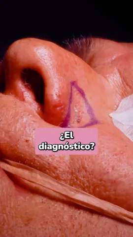 👃 Un “grano” en la nariz que escondía un carcinoma 👨‍⚕️ Caso real: paciente masculino de 62 años llegó a consulta pensando que tenía un “grano” en la nariz. 🔬 Al realizar la dermatoscopia, descubrimos que se trataba de un carcinoma basocelular pigmentado, un tipo de cáncer de piel que puede confundirse fácilmente con: Un grano común 🤷‍♂️ Un traumatismo 💥 O incluso un melanoma ⚠️ ✂️ Hoy realizamos la resección con márgenes amplios, tratamiento indicado para erradicar este tipo de tumores. ☀️ Recuerda: revisa tu piel periódicamente, usa protector solar y acude con un especialista en oncología y piel. Tu salud puede depender de ello. #CáncerDePiel #Salud #drcastelazo