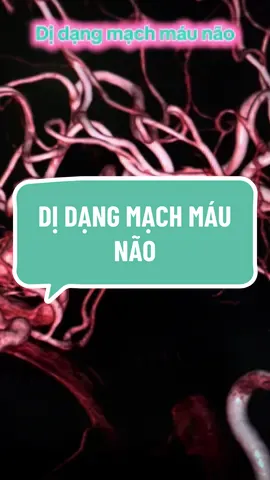 dị dạng mạch máu não  #dotquy #bsbinh #stent 