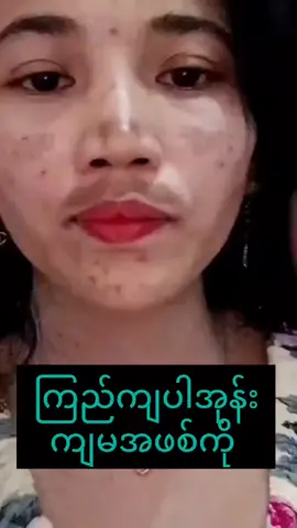 #ဘာသုံးသုံးတင်းတိတ်မပျောက်သူတွေ #တင်းတိတ်ပျောက်ချင်သူများအတွက် #tiktok #foryou #တေွးပြီးမှတင်ပါ 