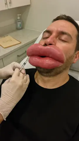 Men get lip filler too #aiartwork