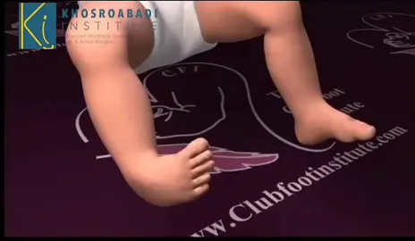 “Clubfoot is a birth deformity where the baby’s foot turns inward due to abnormal bone position. With early Ponseti treatment, casting, and bracing, clubfoot can be fully corrected. Timely care gives every child the chance to walk normally and live a healthy life.  #clubfoot #fyp #capcut #everyone #unfreezemyacount 