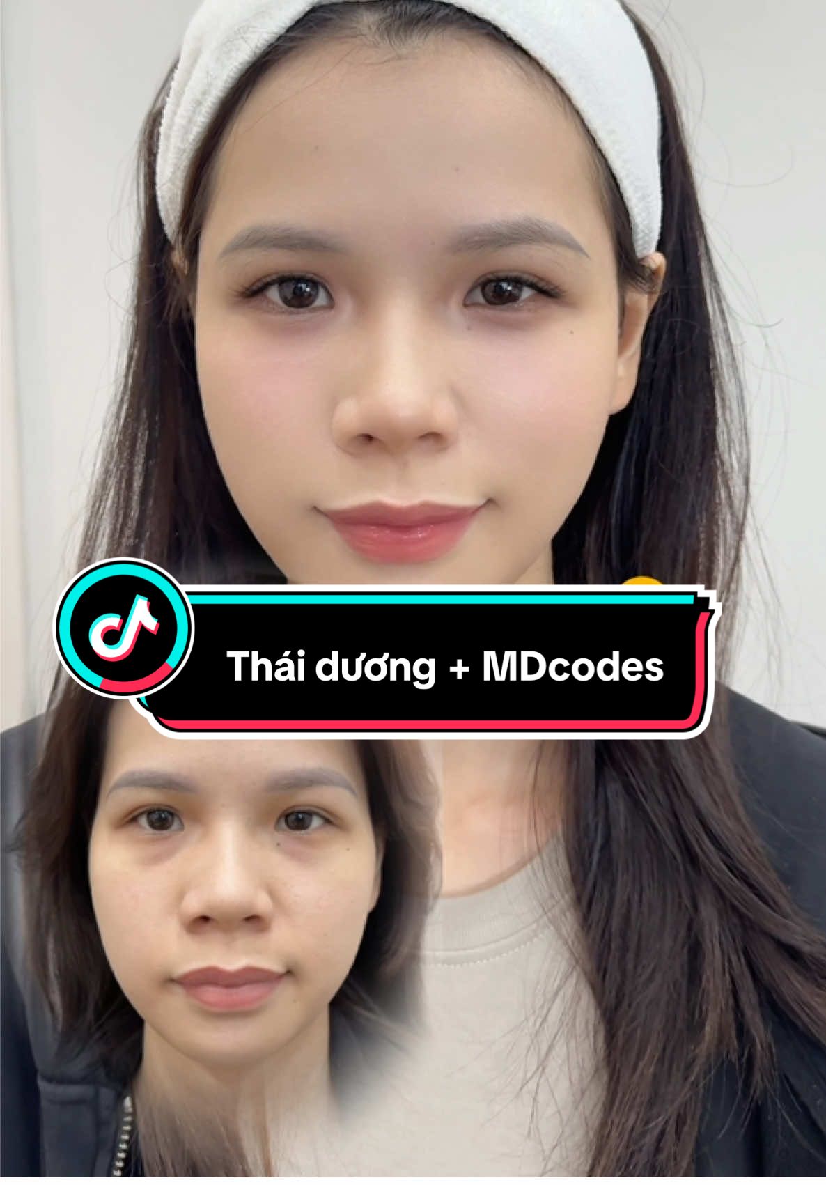 Các bạn có thấy tầm quan trọng của thái dương không ạ,kết hợp làm đầy với kỹ thuật Mdcodes giúp cho gương mặt đẹp tự nhiên mà không để lại đâu vết  #drphamhailinh #tiemthaiduong #mdcodes #fullface #tiemfiiler 