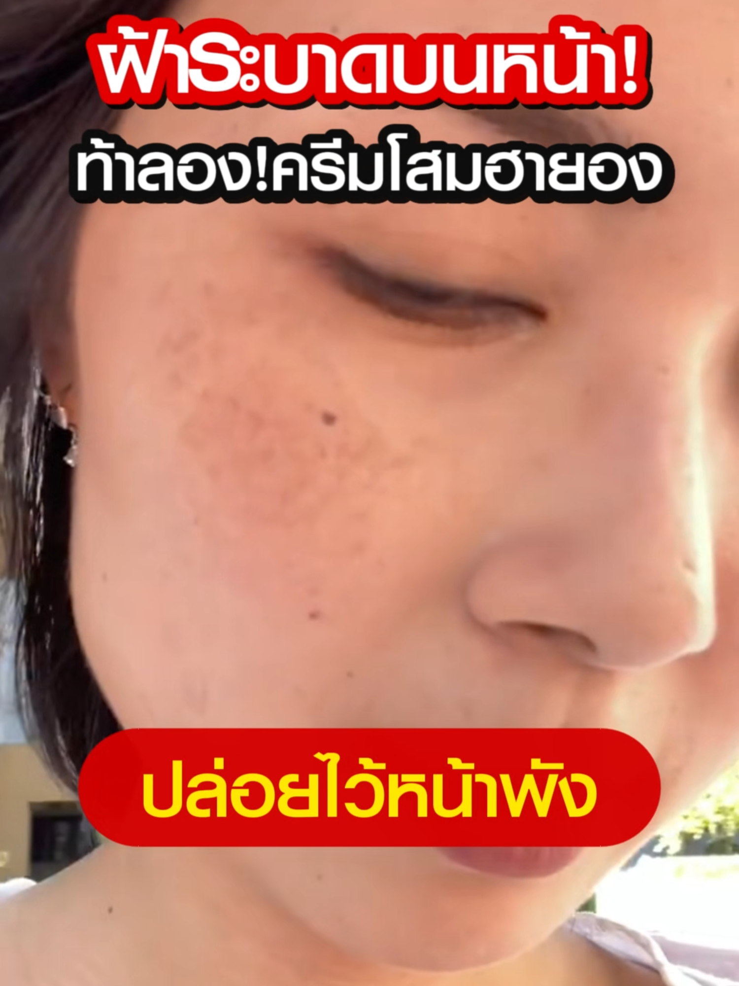 ฝ้าระบาดหนัก!!😖🔥#ฮายอง #ครีมโสมฮายอง #ครีมฝ้า #ฝ้ากระจุดด่างดําจางลง #ครีมโสมแดงเกาหลี