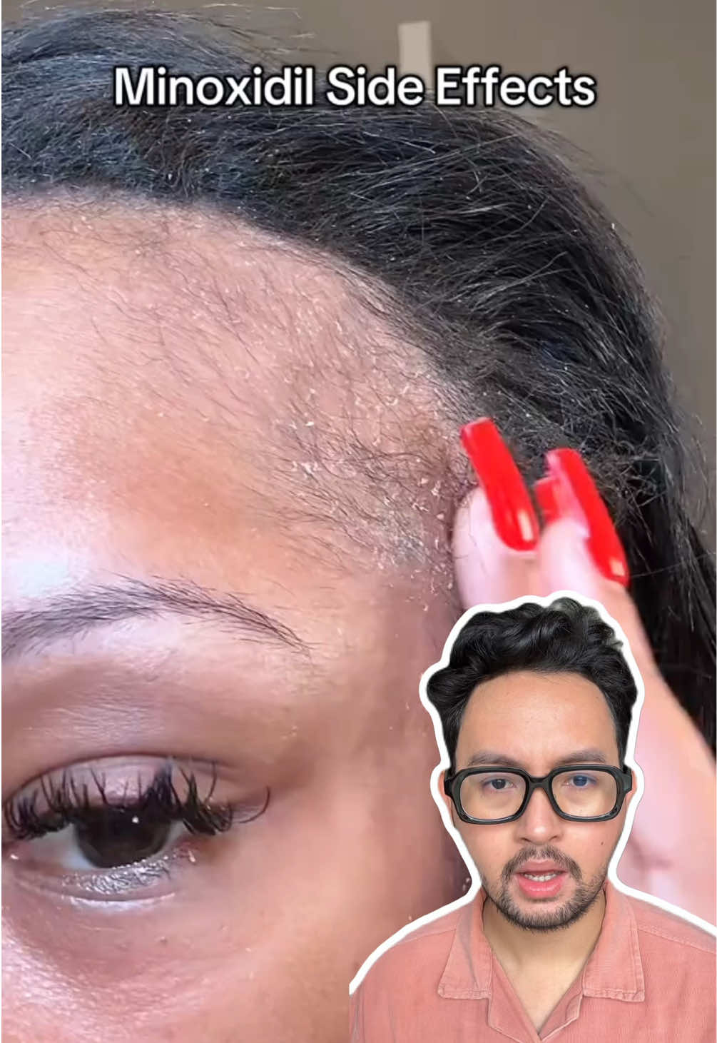 hati-hati yaa kalo kalian mau pake minoxidil, kalo gak cocok atau mau pake yang aman aman aja, bisa pake alternatifnya yaa #hairgrowth #alternativeminoxidil 