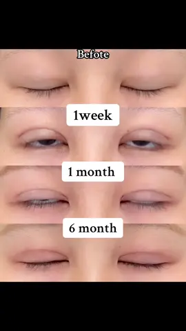 Quá trình hồi phục mí. Cắt mí đẹp tại Bắc Ninh #xuhuongtiktok #bacninh #catmi #sửamihỏng #suami 