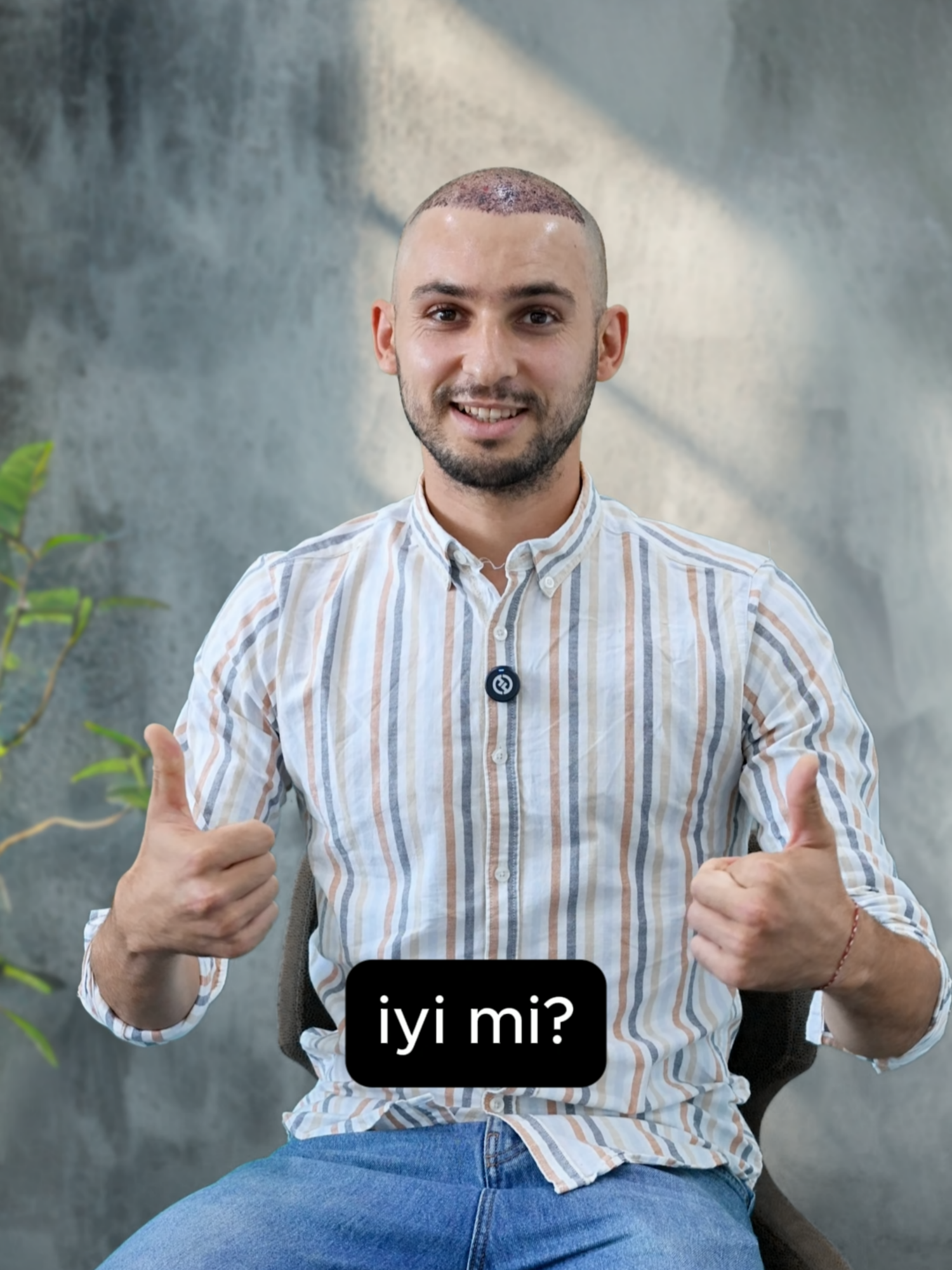 Voici comment s’est passée ma greffe de cheveux ! #operation #hairtransplant #greffedecheveux #hairtransplantprogress #newlife