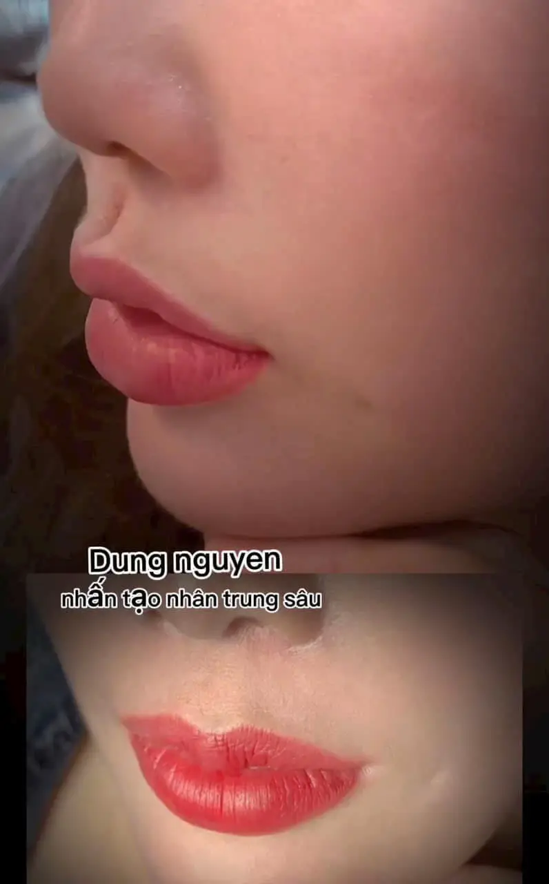 1 chiếc nhân trung đẹp cho e gái #nhấnnhântrung #taoranhnhantrung #ldungnguyen #thammy #xuhuong 