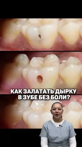 Смотри, как мы закрываем дырку в зубе за одно посещение. Всё просто, быстро и комфортно. #техника #кариес #терапевт #улыбка 