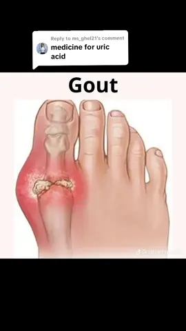 Replying to @ms_ghel21 Uric Acid #creatorsearchinsights #hospital #dr #pharmacy #Viral 