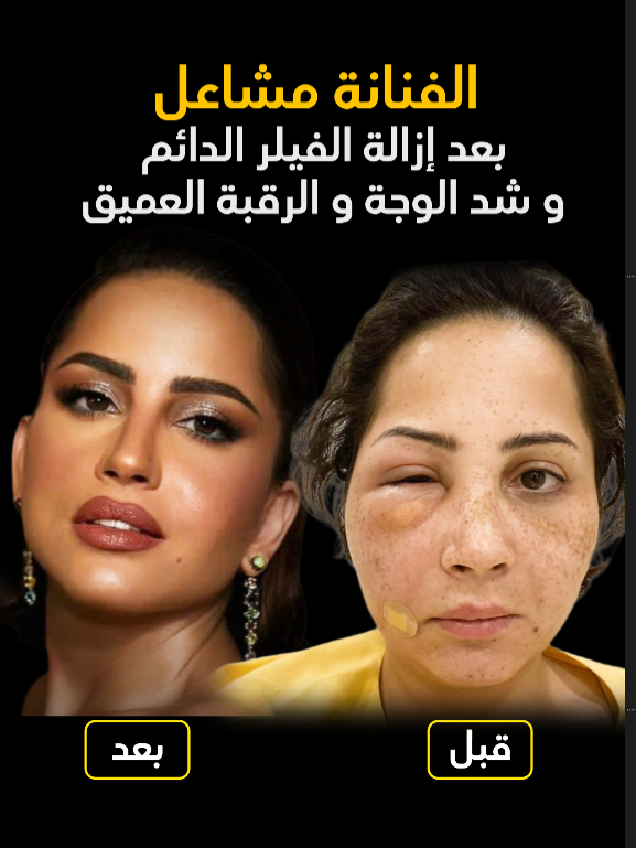 الفنانة مشاعل و رحلتها معنا في أزالة الفيلر الدائم و شد الوجة و الرقبة العميق  #فالح_الشهراني #تقديم_الفك #شد-الوجة #شد_الرقبه #تجميل #عمليات #الفنانه_مشاعل #مشاعل