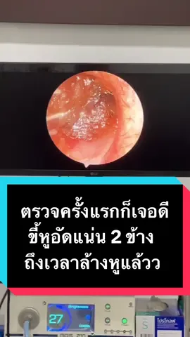 คืนนี้มีขี้หูแน่นจัดเต็มมาฝากฮีลใจก่อนนอนค้า #พี่หมอเปย่าหูคอจมูก #earwax #หูอื้อ #tiktokuni #ขี้หู