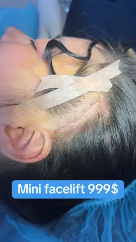 #surgery #operation #cangdamat #cangdamini #minifacelift 