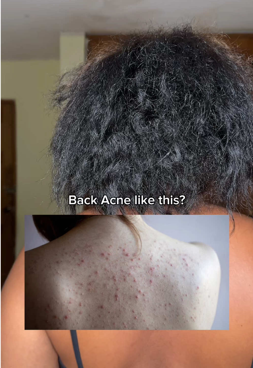 If you want to keep your back free of acne, you should use this cream from @PURITO SEOUL 🤩✨ #Purito #PanthenolCream #AcneTreatment #RealPostAcneCream #RealPostAcneCreamChallenge