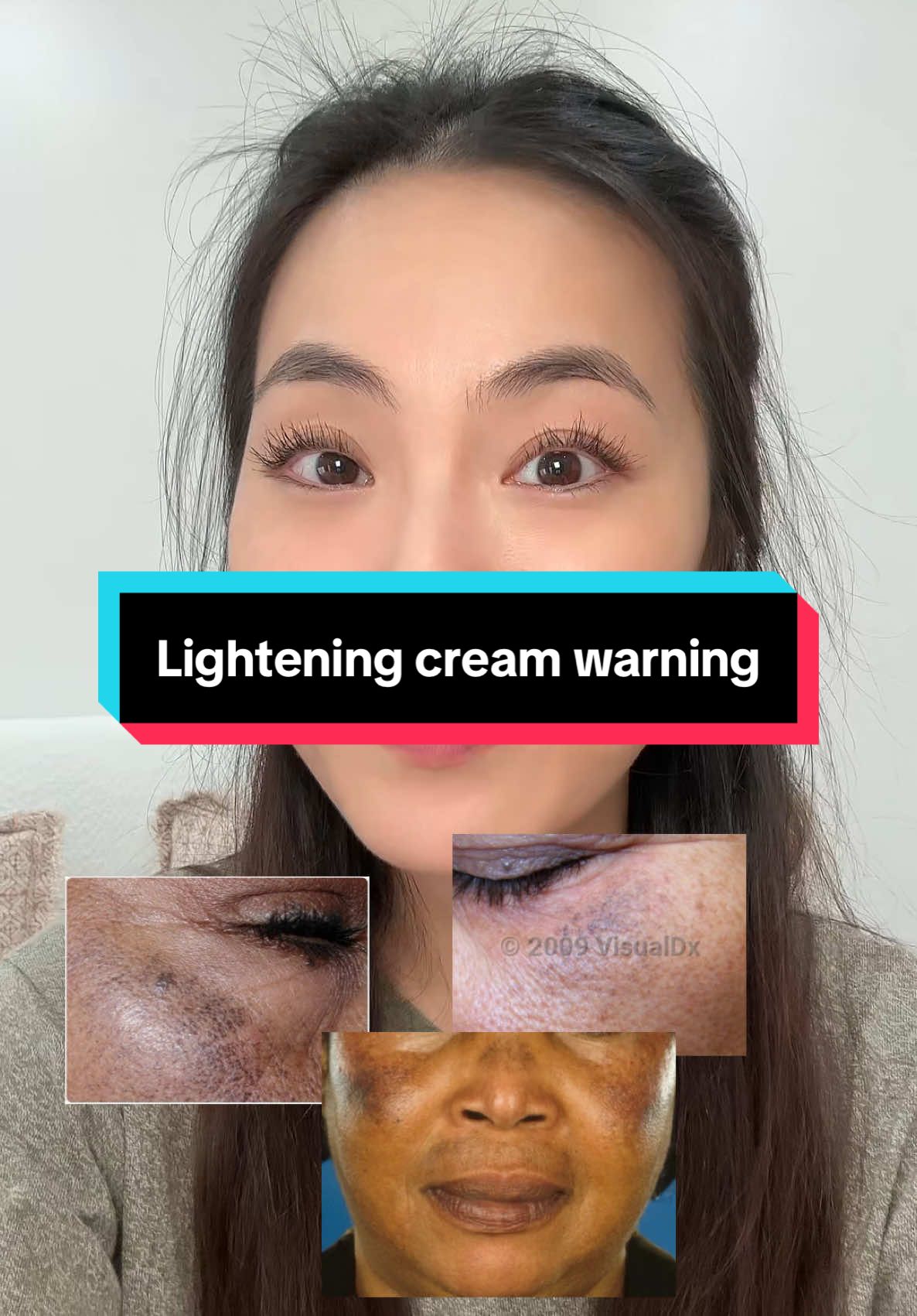 If you’re an avid hydroquinone or “bleaching cream” user, this one’s for you! Exogenous ochronosis is much easier to prevent than it is to treat so make sure you check in with your dermatologist if you’re concerned!  #hydroquinone #bleachingcream #sunspots #skincare #laser #dermatologist #ochronosis 