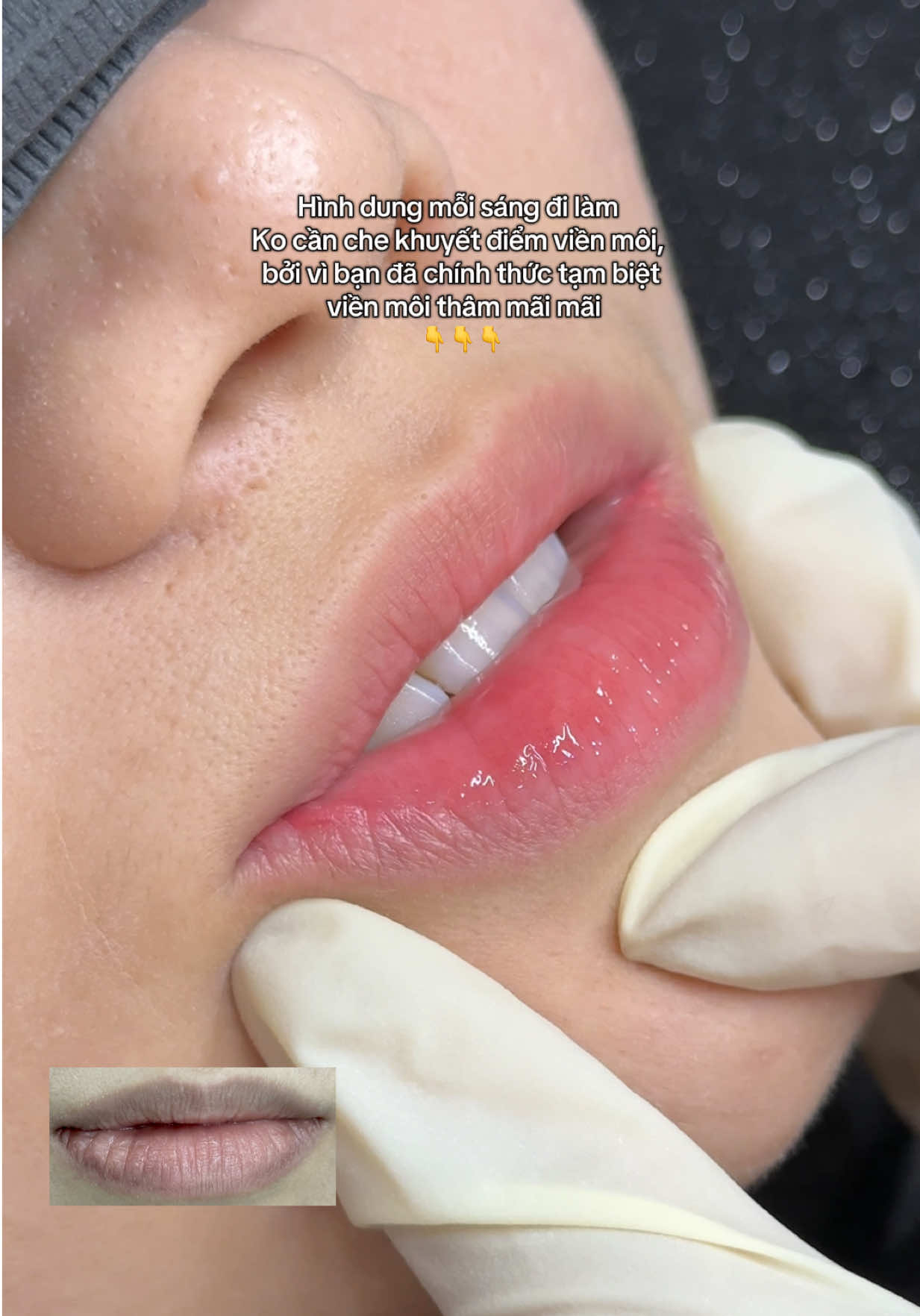 Môi sau bong 2 tháng. Màu đã ổn định. Do có bôi lớp son dưỡng nên nhìn hơi bóng. Và bạn í sắp được bên mình dặm nhẹ thêm để hết thâm hoàn toàn và ửng hồng đẹp nhất có thể 🤗 #natepic #khuthammoi #phunmoitunhien #phunmoitanvien #hcm 