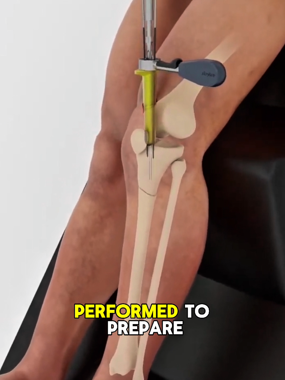 Tibia Repair Surgery | Complete Procedure Explained 👨‍⚕️🦴. #TibiaRepair #BoneSurgery #MedicalEducation #OrthopedicSurgery #MedicalStudents     