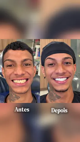 “Antes: dentes muitooo tortos, amarelos e pontas quebradas.  Depois: sorriso de estrela ⭐🔥. Quem vê até pensa que já nasceu MC 😁🎤.” Procedimentos: ortodontia auto ligada, clareamento dental e resina nas pontas dos 4 dentes da frente. 😱 Paciente querido: @iurybleyner__  de Matozinhos MG #ortodontiaautoligada  #clareamentodental